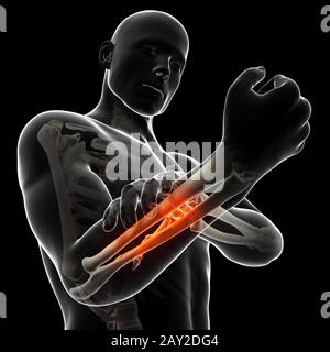 3d rendered illustration - painful arm Stock Photo