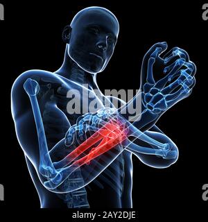 3d rendered illustration - painful arm Stock Photo