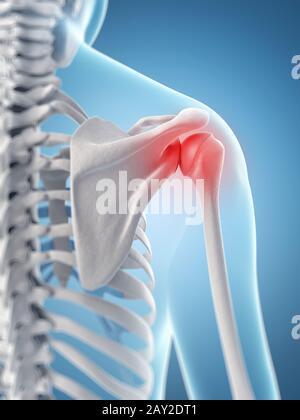 inflamed shoulder joint Stock Photo