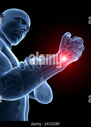 3d rendered medical illustration - painful wrist Stock Photo