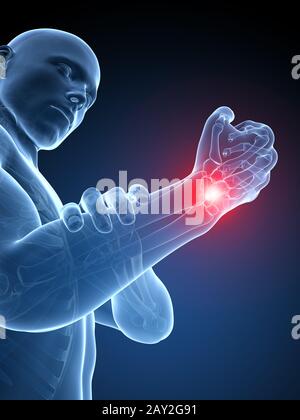 3d rendered medical illustration - painful wrist Stock Photo