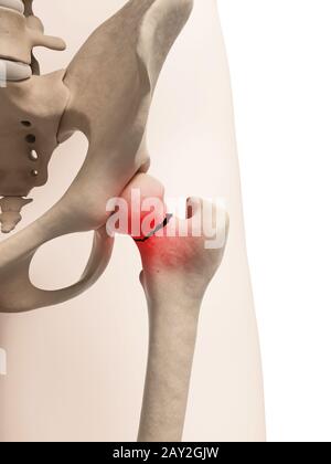 medical illustration of broken hip Stock Photo