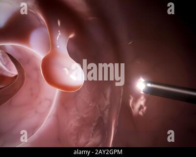 3d rendered illustration of a colonoscopy Stock Photo