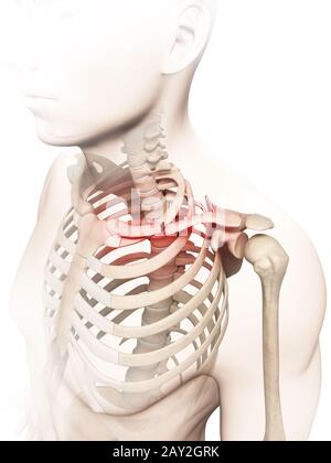 medical illustration of a broken clavicle Stock Photo