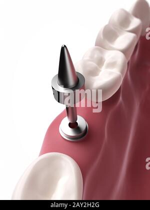 3d rendered illustration of a dental implant Stock Photo