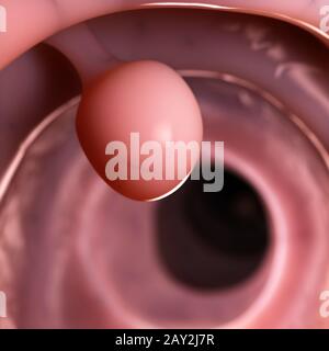 3d rendered illustration - colon polyp Stock Photo