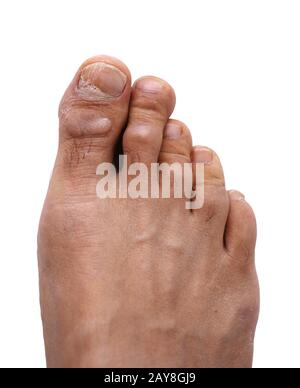 Cutout of male caucuasian right foot with overgrown cuticle on big toe, flaky nail on big toe and corns on joints of the big and index toes. Stock Photo