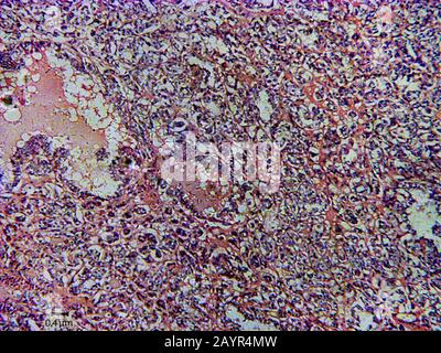 histological cut of tissue of a scirrhous thyroid cancer, 500 x Stock Photo