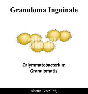 Inguinal granuloma. Bacterial infections. Sexually transmitted diseases. Infographics. Vector illustration on isolated background. Stock Vector