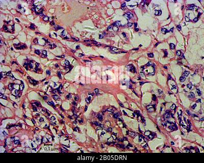 histological cut of tissue of a scirrhous thyroid cancer, 2000 x Stock Photo