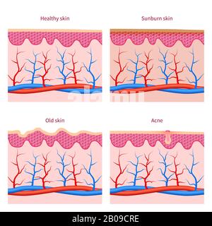 Skin types and healthy, sunburn and old skin, acne vector set. Human skins layer illustration Stock Vector