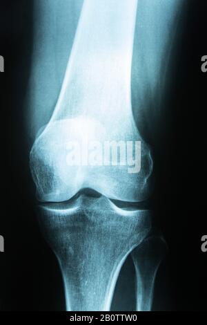 xray scan of a knee fraom a woman Stock Photo