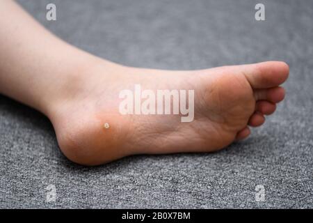 Foot wart, verrucas plantar on the foot of a child. A decease caused by the Human papillomavirus and often spread at communal showers. Stock Photo