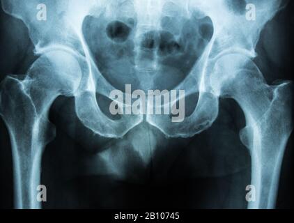 pelvis xray scan Stock Photo