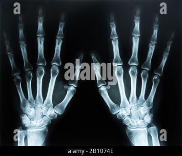 xray scan of hand Stock Photo