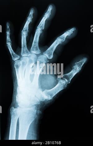 xray scan of hand Stock Photo