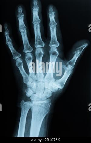 xray scan of hand Stock Photo