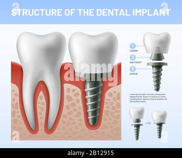 Dental teeth implant. Implantation procedure or tooth crown abutments. Health care vector illustration Stock Vector