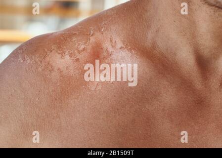 Sunburn on the shoulders of men. Shoulders with hurt skin fron sun burn, closeup Stock Photo