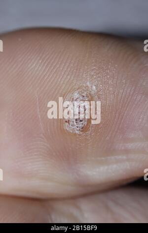 HPV Close-up shot of a plantar wart on the bottom of the big toe caused by the human papillomavirus. Stock Photo