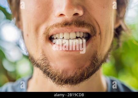 Man placing a bite plate in his mouth to protect his teeth at night from grinding caused by bruxism Stock Photo