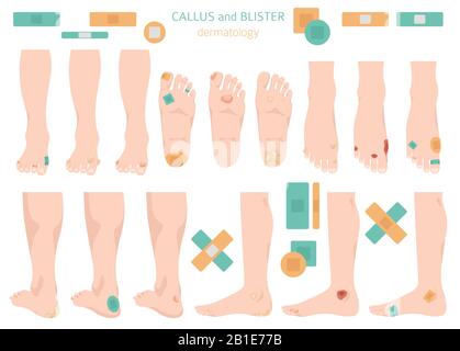 Callus, corn and blister feet and hands. Dermatology. Medical desease infographics collection. Vector illustration Stock Vector