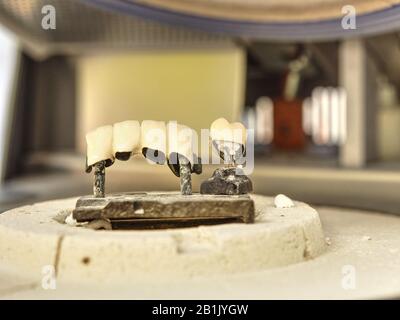 Tooth, metal ceramic crown on the table. Denture made of metal ceramics. Stock Photo