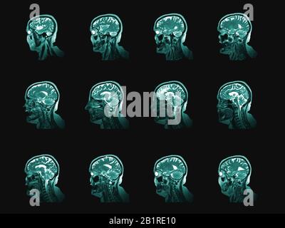 Human head and brain computer tomography image set. Vertical partition of medical examining or anatomy study Stock Photo