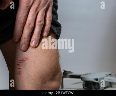 scratches from quadcopter. damaged skin. Scratch on leg. Stock Photo