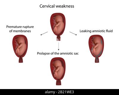 Leaking amniotic fluid, illustration Stock Photo - Alamy