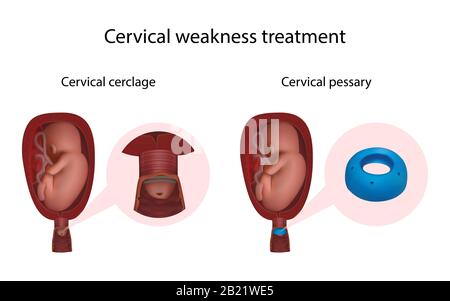 Cervical weakness, cerclage and pessary, illustration Stock Photo