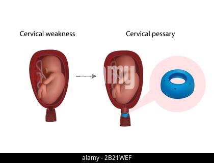 Cervical pessary, illustration Stock Photo