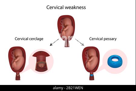 Cervical weakness, cerclage and pessary, illustration Stock Photo