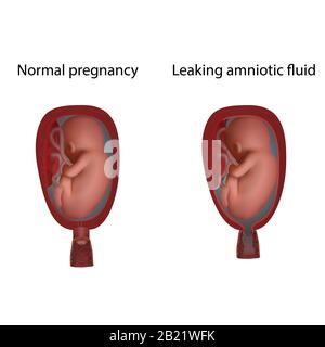 Leaking amniotic fluid, illustration Stock Photo - Alamy