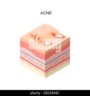 Acne vulgaris or pimple cross-section of human skin layers structure skincare medical concept flat vector illustration Stock Vector