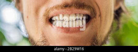 Man placing a bite plate in his mouth to protect his teeth at night from grinding caused by bruxism BANNER, LONG FORMAT Stock Photo