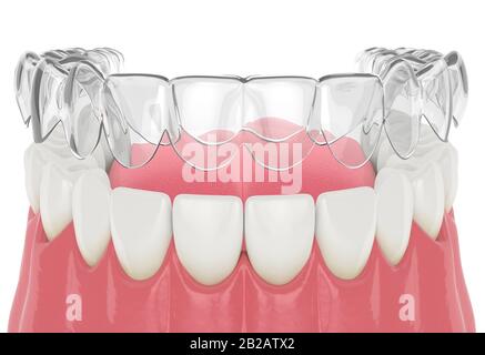 3d render of invisalign removable and invisible retainer with lower jaw over white background Stock Photo