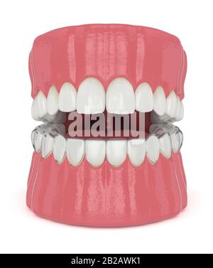 3d render of jaw with invisalign removable retainer with jaw over white ...