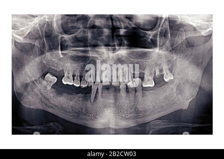 Orthopantomogram Meaning Why Use A Palatal Expander In Orthodontics?