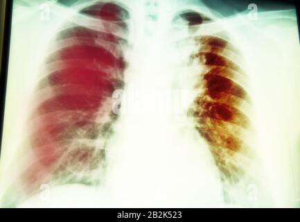 chest x-ray examination for diagnosis Pulmonary tuberculosis infection with  right  lung Stock Photo