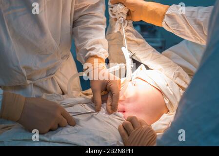 close-up hands of pediatric surgeons perform surgery using laparoscopic ports for endoscopic surgery. In a sterile operating room. Pediatric surgery, Stock Photo