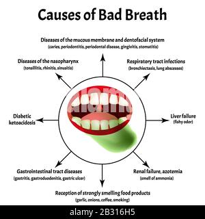 Causes of bad breath. Halitosis. The structure of the teeth and oral cavity. Diseases of the teeth. Infographics. Vector illustration on isolated Stock Vector