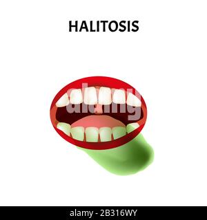 bad breath. Halitosis. The structure of the teeth and oral cavity. Diseases of the teeth. Infographics. Vector illustration on isolated background. Stock Vector