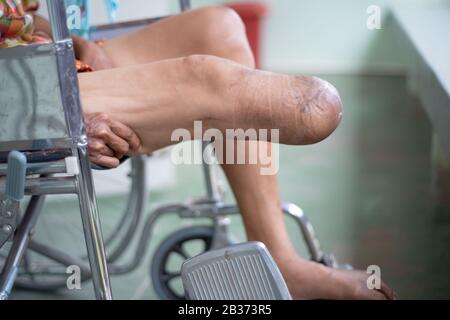 below knee amputated patient sitting on wheelchair, BK device prepared, stump bandage and strength leg Stock Photo