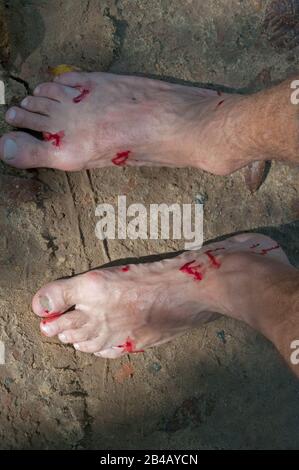 Man's bloody feet close-up. Leech bite after-effect. Stock Photo