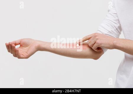 Allergic reaction, itch, dermatitis, dry skin. Man is applying cream/ointment on the swell skin against mosquito bites, isolated on white background, Stock Photo