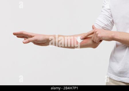 Bouts of allergies concept. Allergic reaction, itch, dermatitis, dry skin. Man is applying cream/ointment on the swell skin against mosquito bites, is Stock Photo