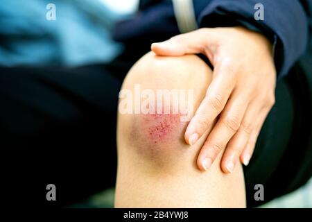 A Female With Scar On Leg Stock Photo - Alamy