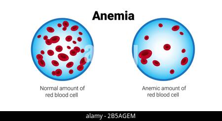 of normal and anemia amount of red blood cells medical board iron deficiency anemia concept horizontal vector illustration Stock Vector