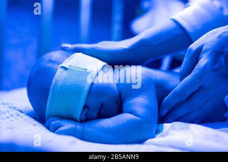 Newborn baby with neonatal jaundice and high bilirubin ...